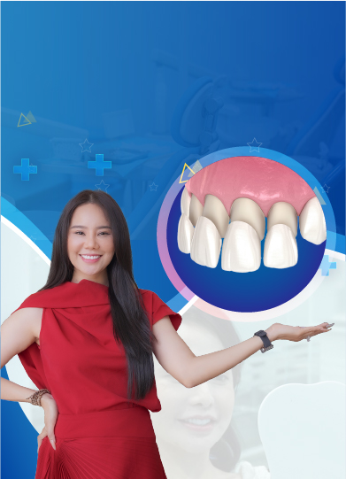 Dịch vụ Dán sứ Veneer