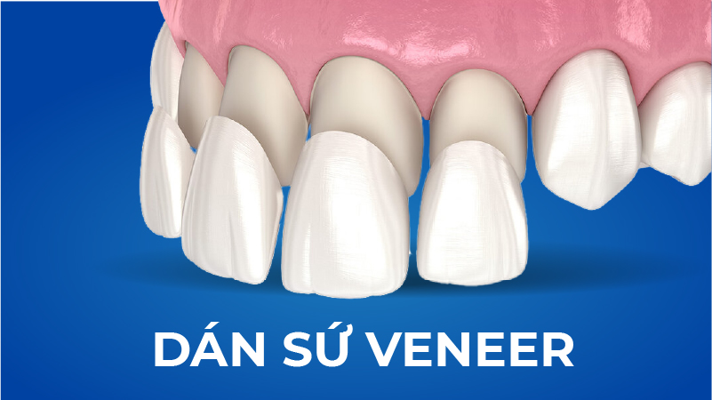 Dịch vụ Dán sứ Veneer_NKAP
