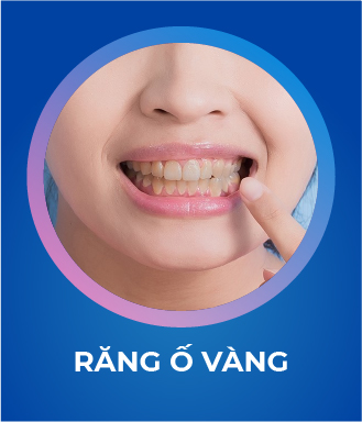 Răng bị ố vàng
