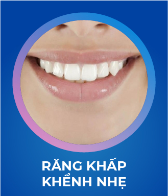 Răng khấp khểnh nhẹ