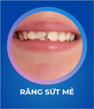 Răng sứt mẻ