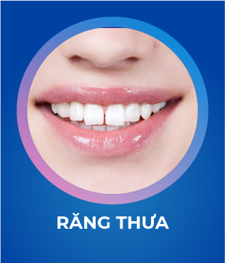 Răng thưa