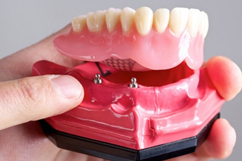 Hàm tháo lắp trên Implant là gì? Khi nào nên thực hiện? Hàm tháo lắp trên Implant có độ bền cao