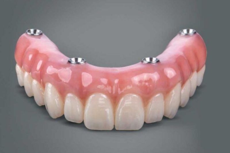 Hàm tháo lắp trên Implant là gì? Khi nào nên thực hiện? Khách hàng có thể tháo hàm và vệ sinh một cách dễ dàng