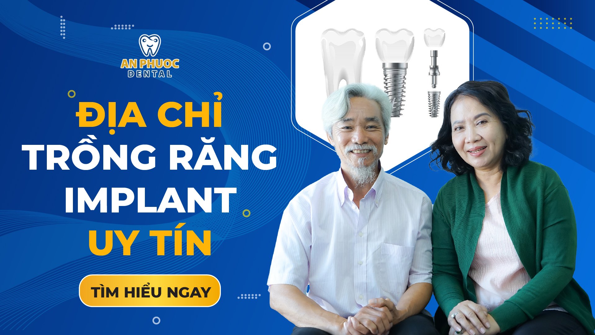 Trồng răng Implant ở đâu tốt nhất? 5 Tiêu chí chọn địa chỉ uy tín Địa chỉ trồng răng Implant uy tín