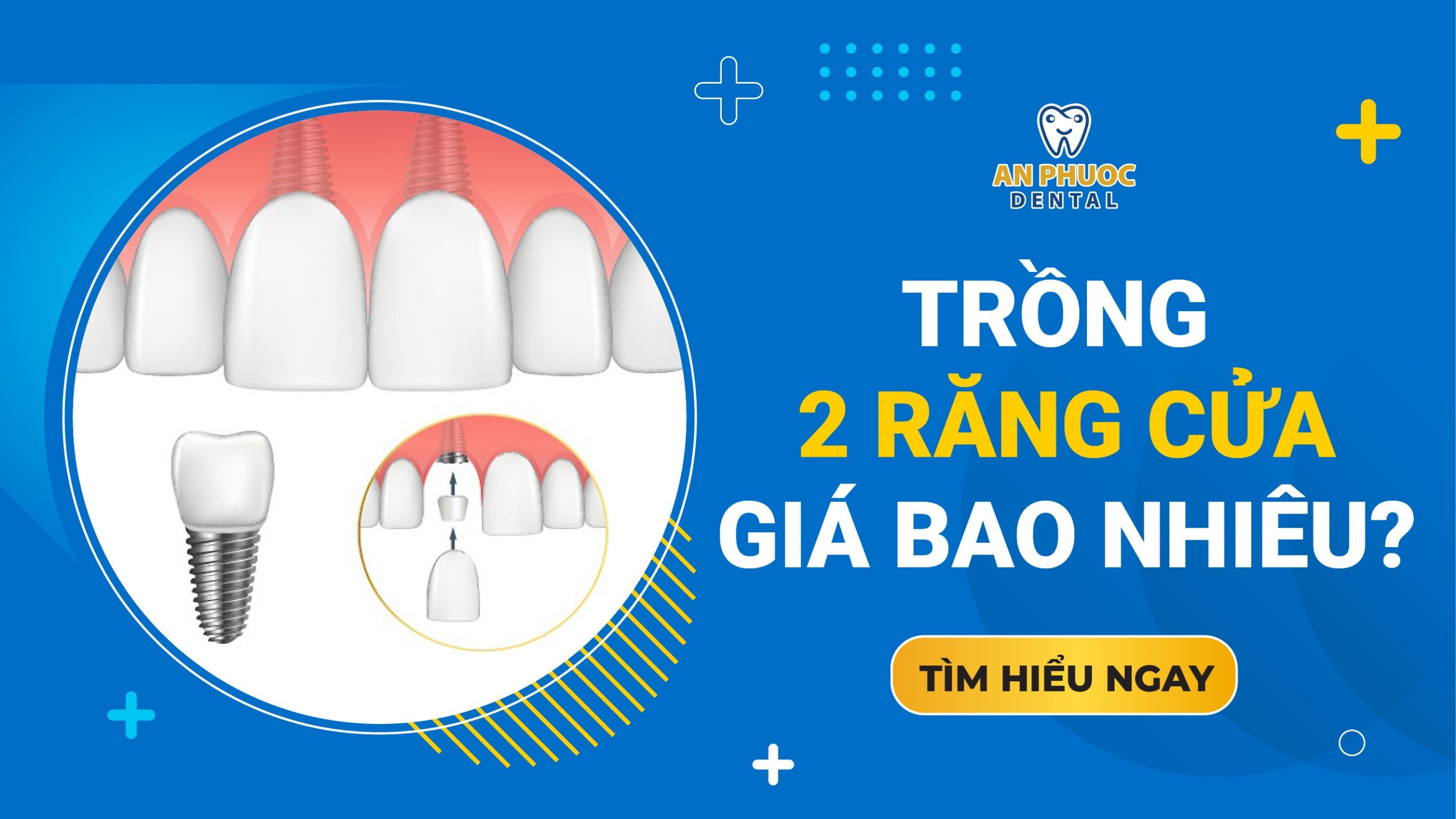 Trồng 2 răng cửa giá bao nhiêu tiền? Bảng chi phí 2025 Trồng 2 răng cửa giá bao nhiêu?