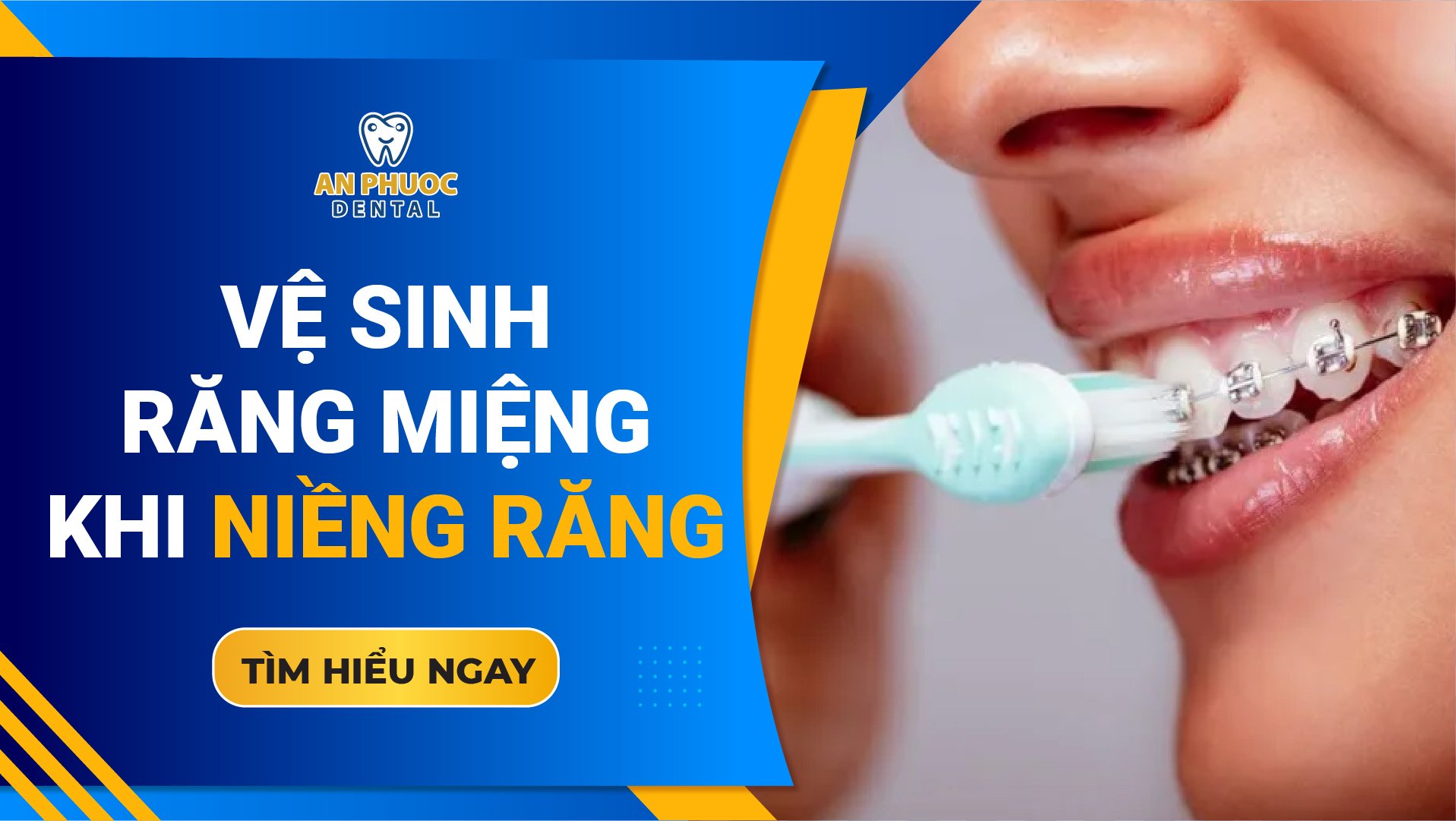 Hướng dẫn chi tiết cách vệ sinh răng niềng hiệu quả nhất Cách vệ sinh răng niềng hiệu quả nhất