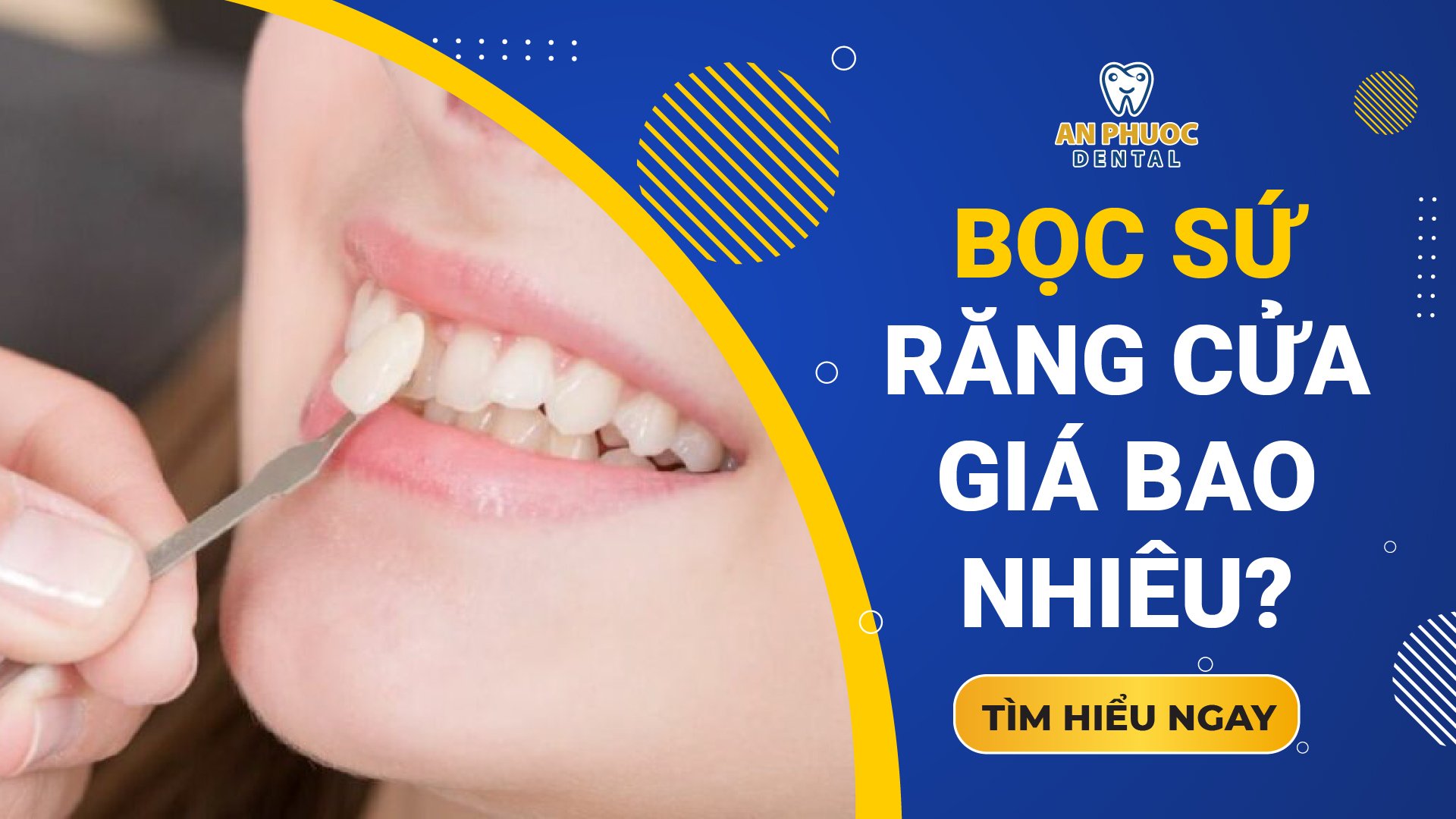 Bọc sứ răng cửa bao nhiêu tiền? Chi phí bọc sứ răng cửa 2025 Giá bọc sứ răng cửa