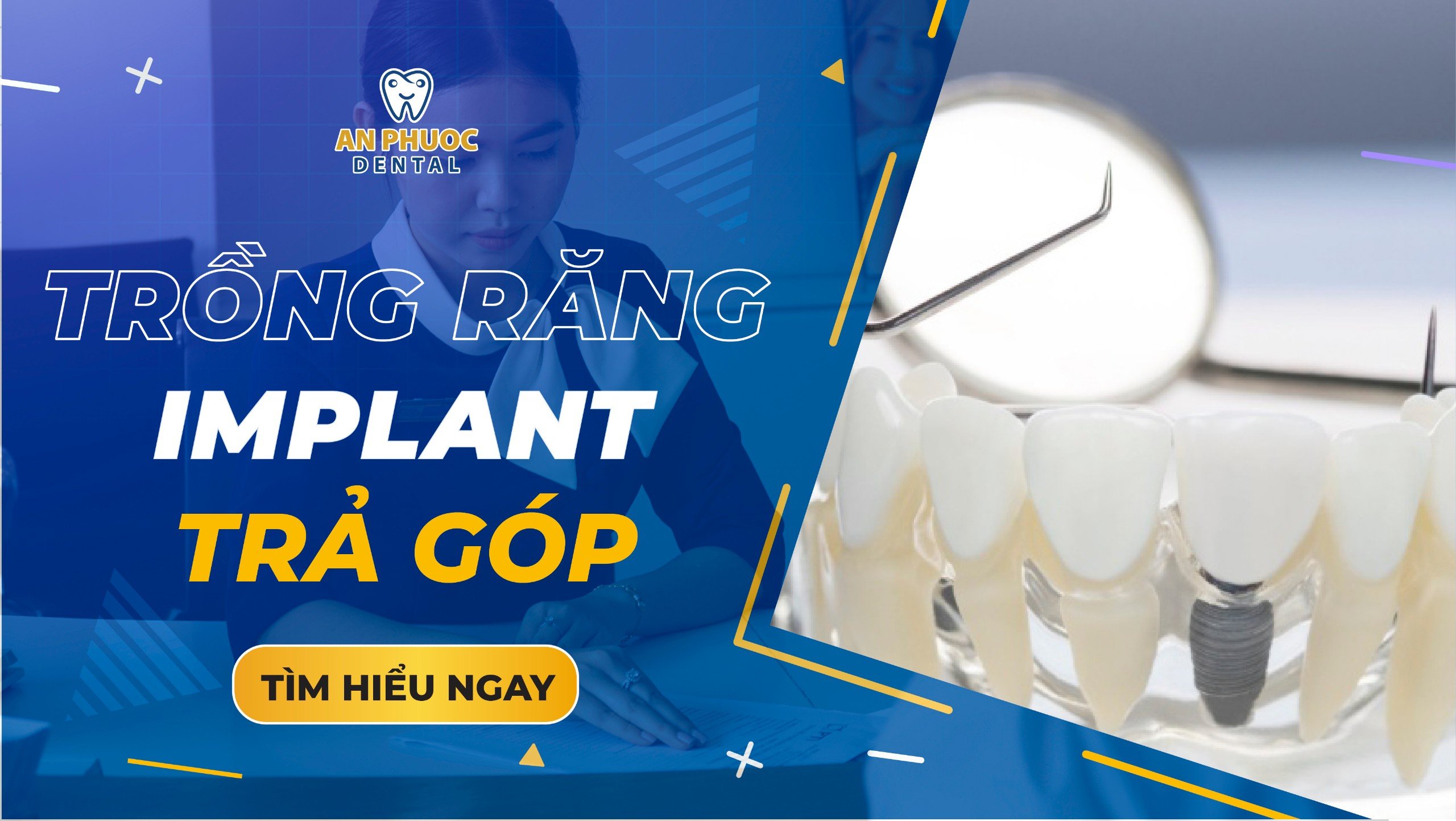 Trồng răng Implant trả góp