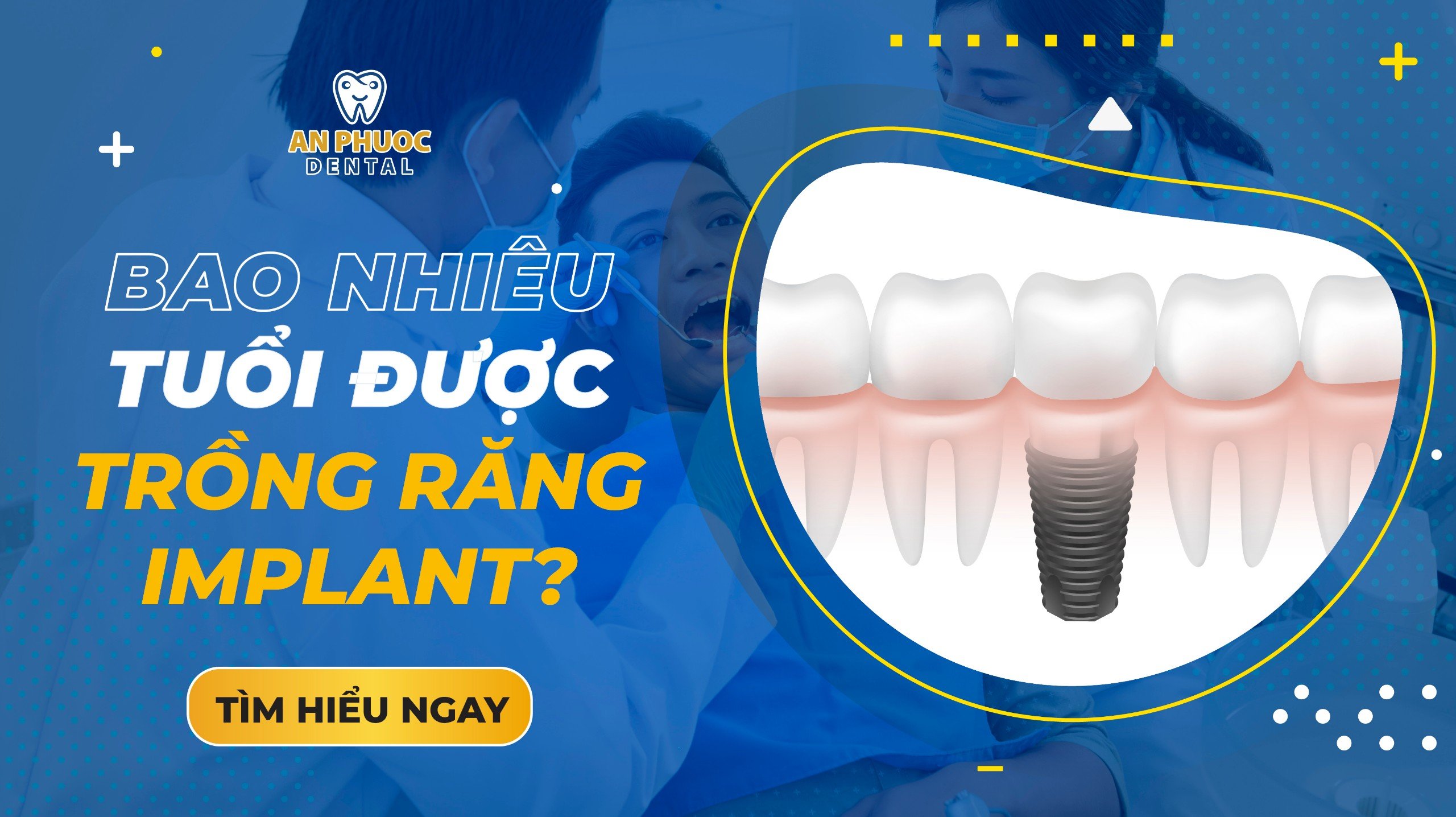 Bao nhiêu tuổi được trồng răng Implant