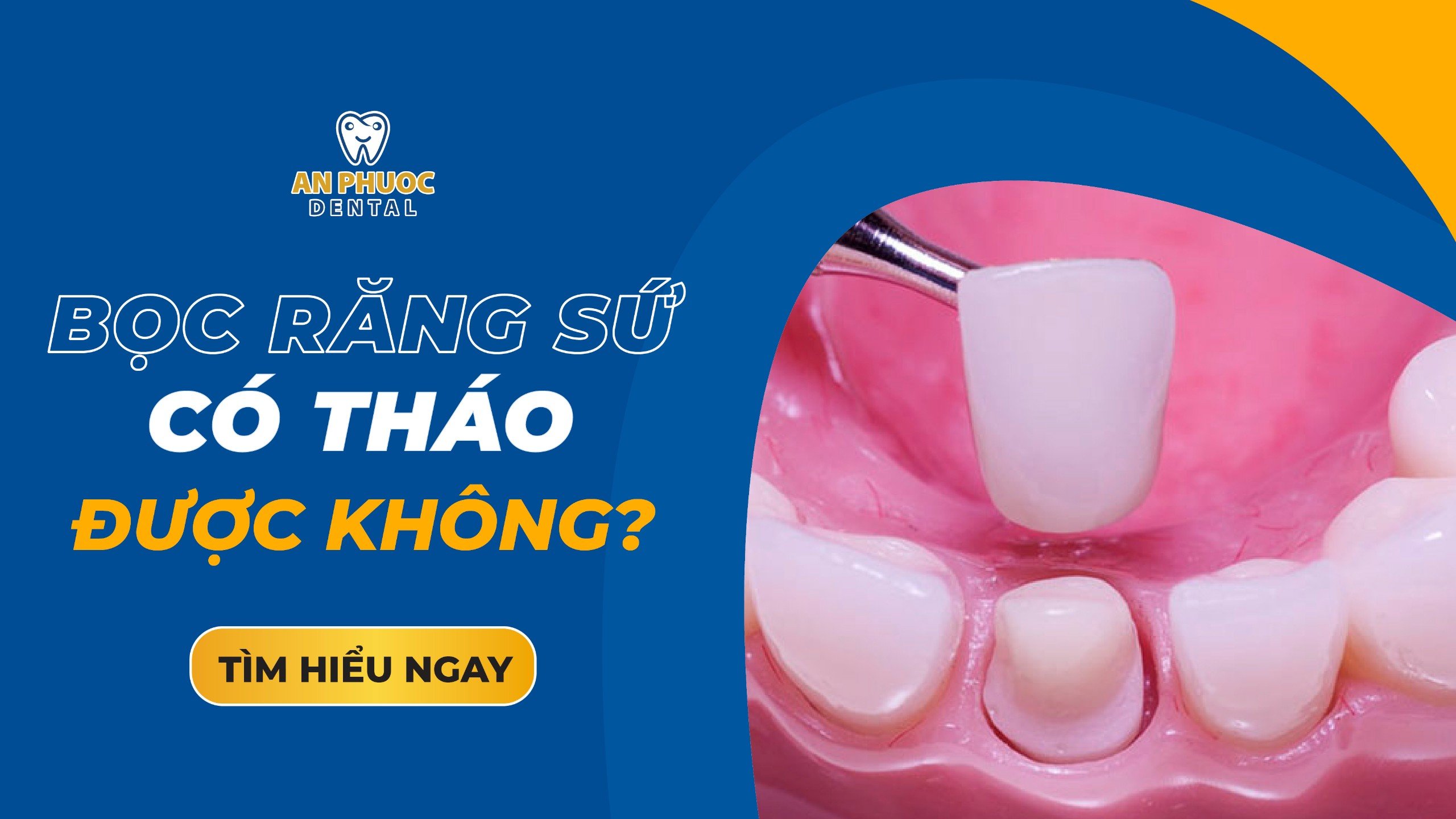Bọc răng sứ có tháo ra được không? Có đau không, ảnh hưởng gì không? Bọc răng sứ có tháo được không?