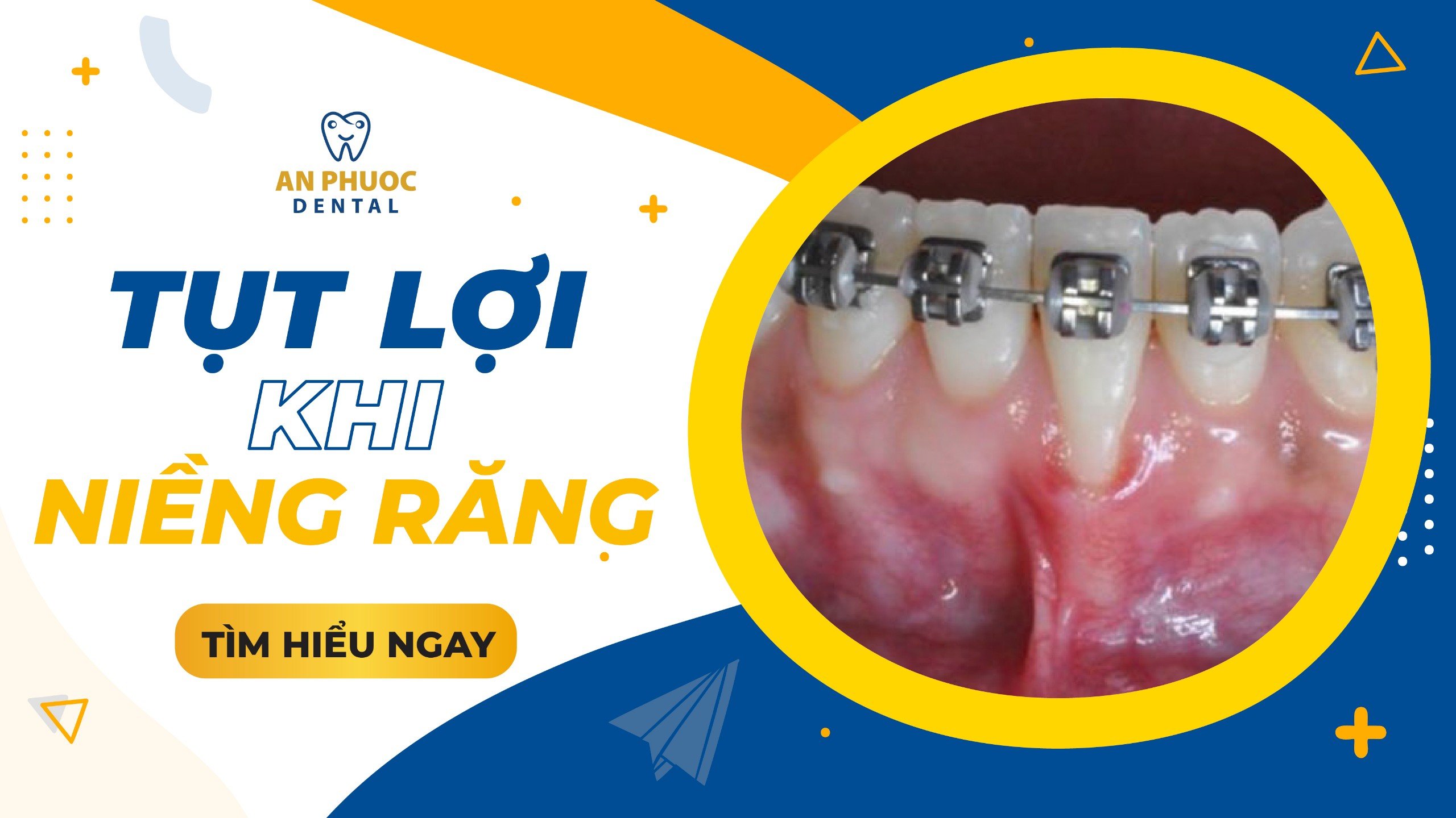 Tụt lợi khi niềng răng: Dấu hiệu, nguyên nhân và cách khắc phục Tụt lợi khi niềng răng