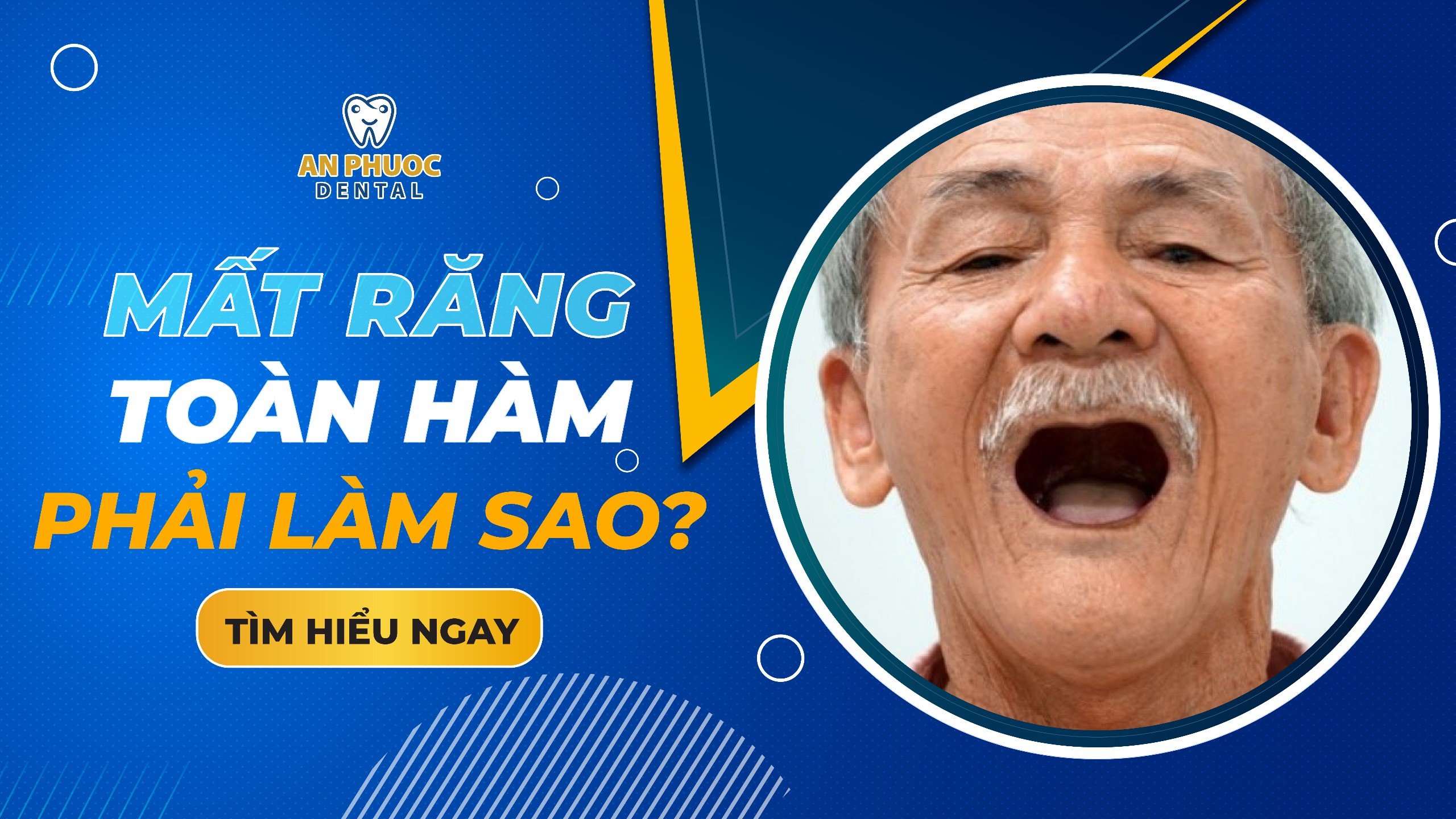 Mất răng toàn hàm do đâu? Hậu quả và cách khắc phục Mất răng toàn hàm phải làm sao