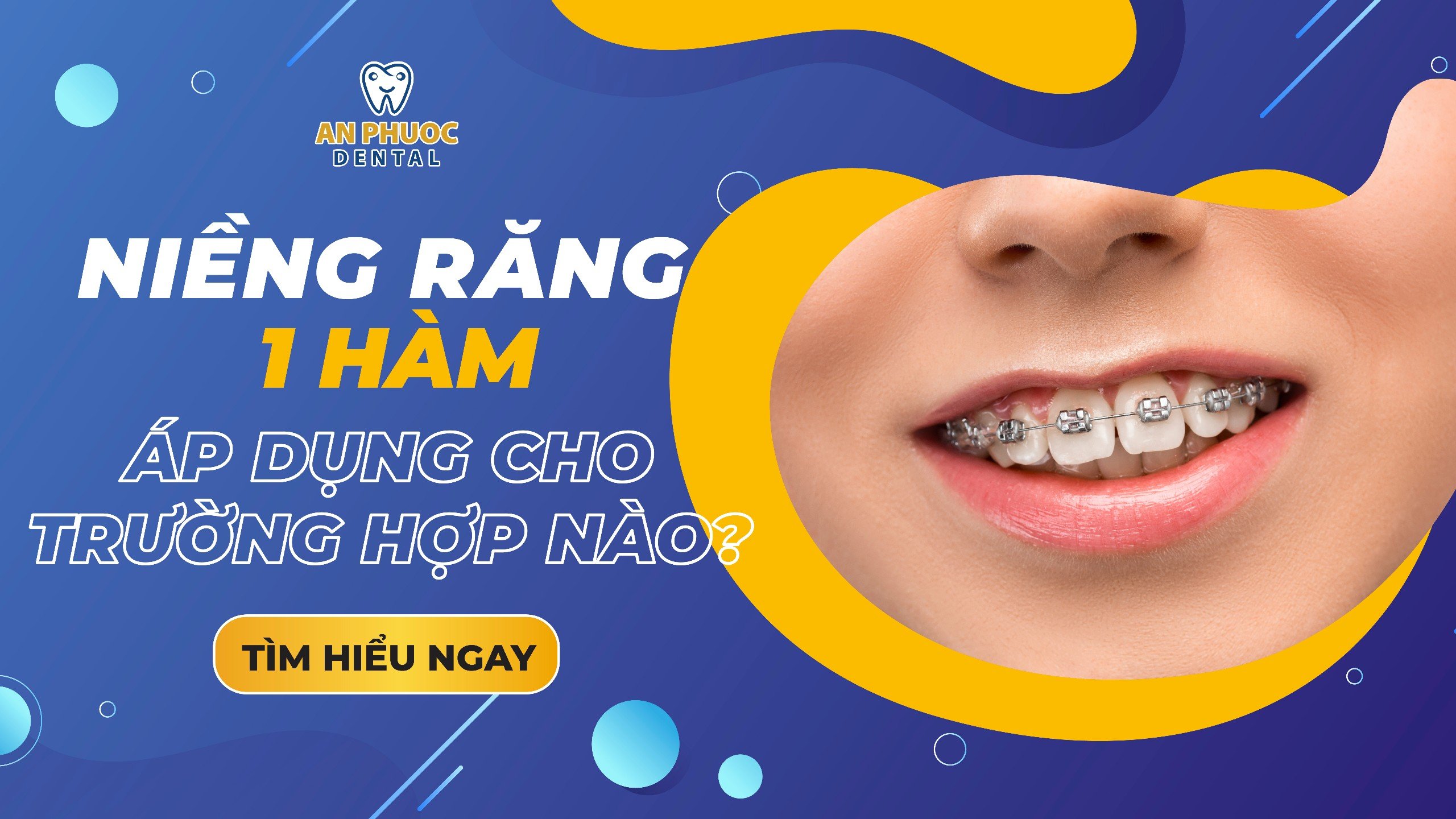 Niềng răng 1 hàm có được không? Áp dụng cho trường hợp nào? niềng răng 1 hàm có được không