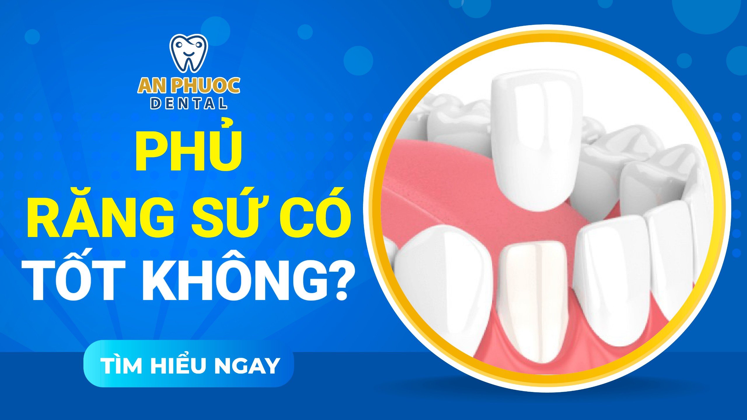 Phủ răng sứ có tốt không? Trường hợp nào nên thực hiện Phủ răng sứ có tốt không