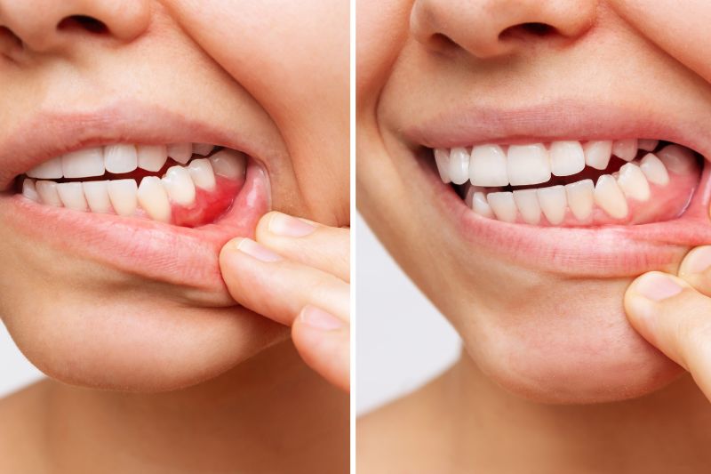 Khớp cắn ngược có nguy hiểm không? Nguyên nhân, phương pháp điều trị Khớp cắn ngược có thể dẫn đến những bệnh lý răng miệng nguy hiểm