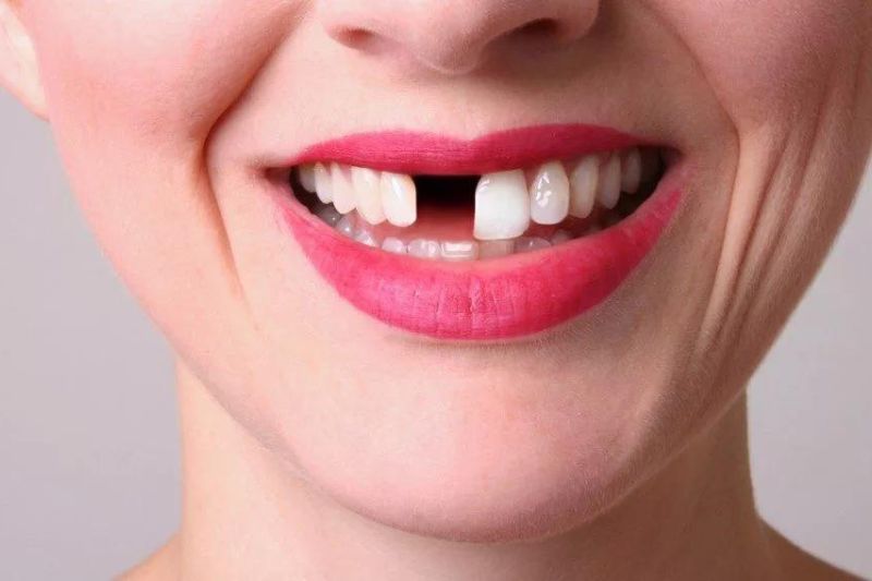 Các phương pháp trồng răng cửa hiện nay. Địa chỉ trồng răng cửa uy tín Mất răng cửa ảnh hưởng đến thẩm mỹ và ăn nhai