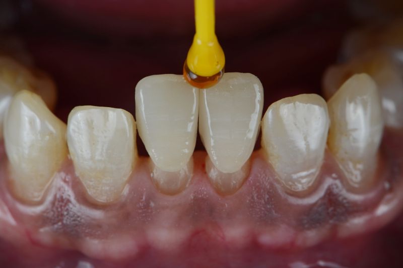 Biến chứng khi bọc răng sứ bị lệch khớp cắn, khắc phục như thế nào? Thay thế răng sứ mới để khắc phục hậu quả răng sứ hỏng