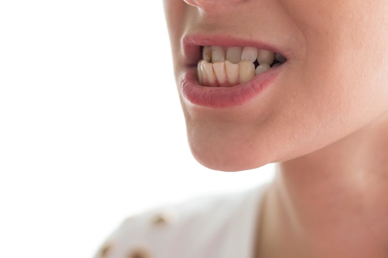 Khớp cắn ngược có nguy hiểm không? Nguyên nhân, phương pháp điều trị Tình trạng khớp cắn ngược