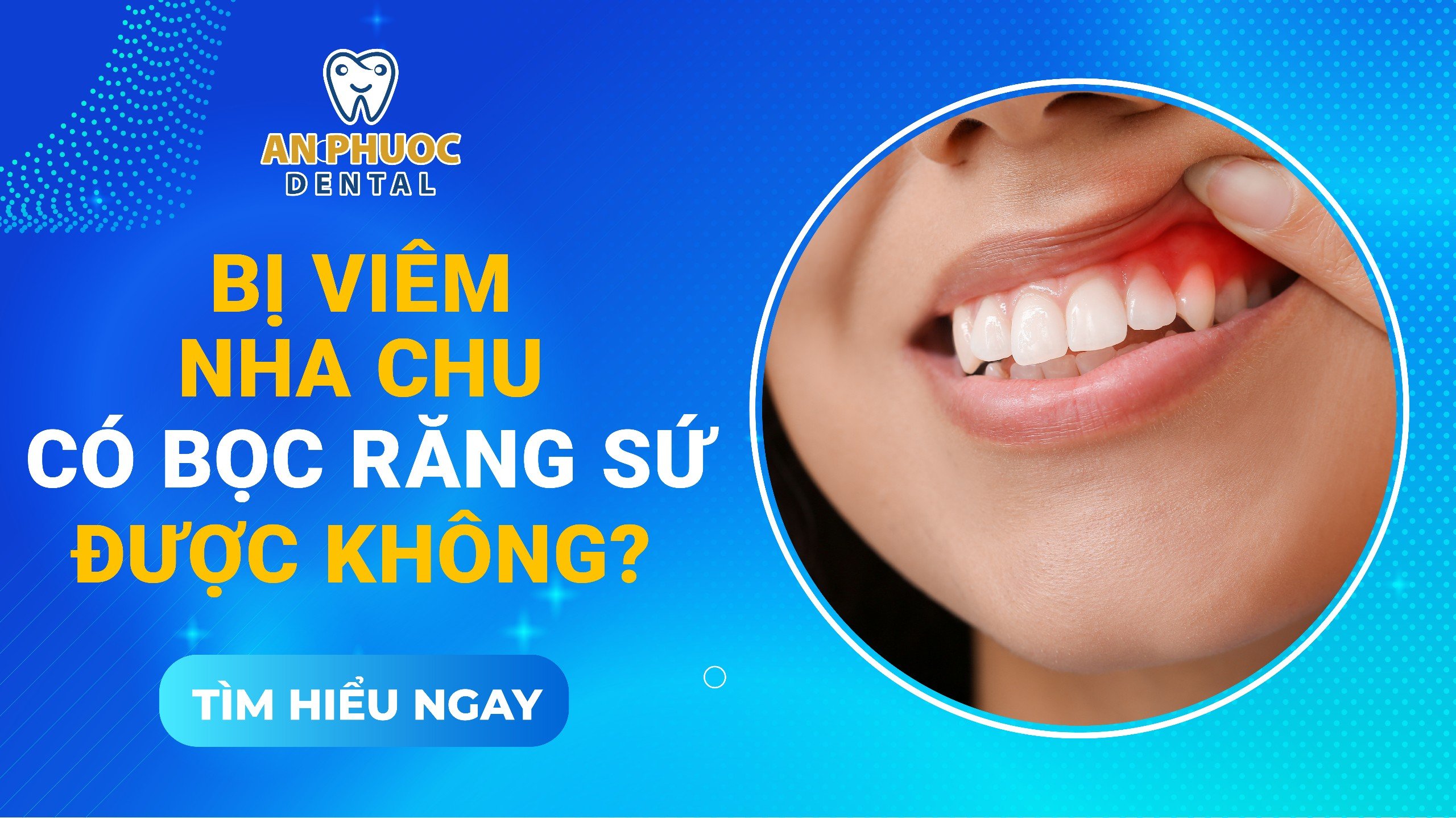 Bị nha chu có bọc răng sứ được không? Lời khuyên từ chuyên gia Viêm nha chu có bọc răng sứ được không