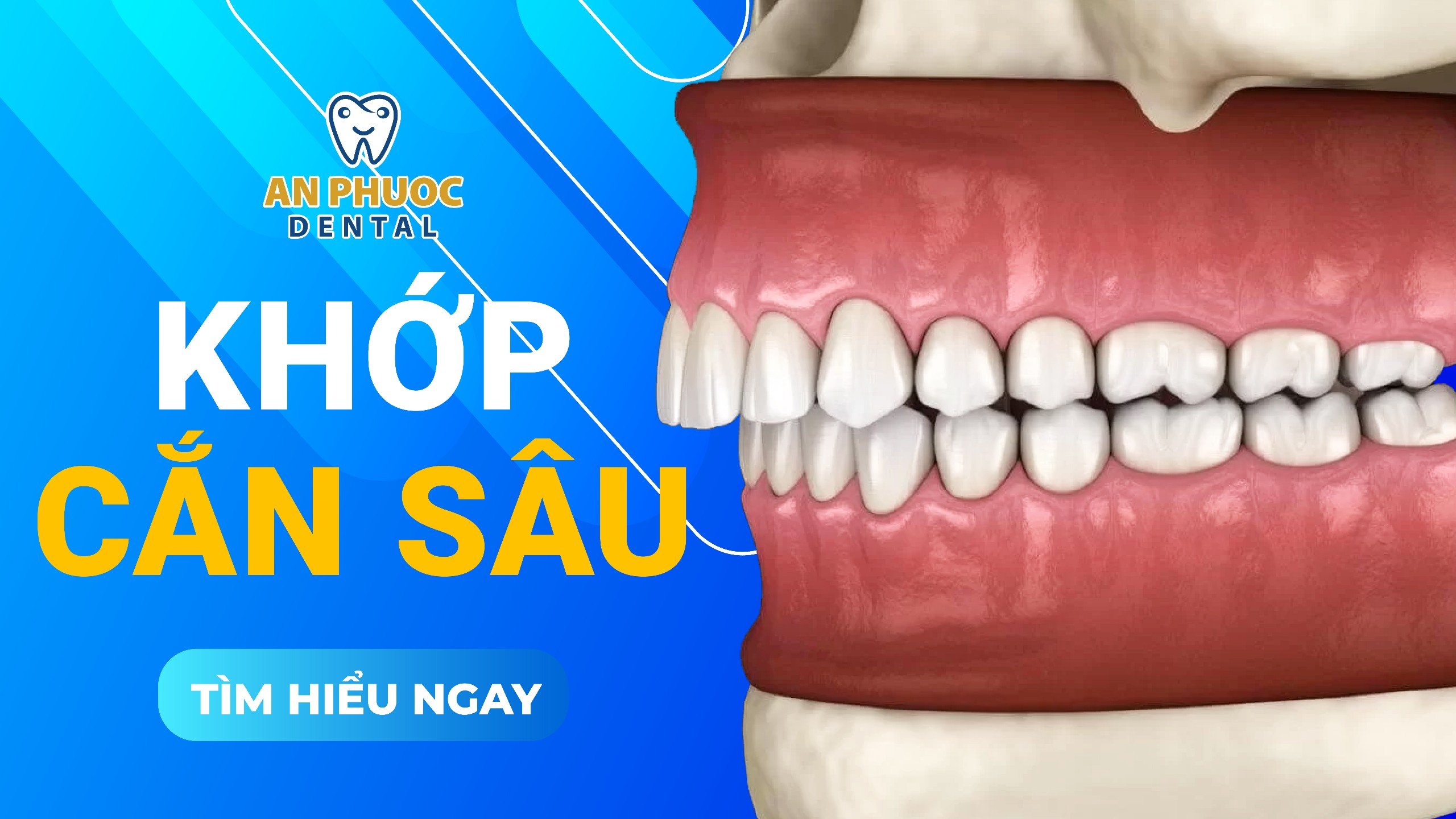 Nguyên nhân, tác hại khớp cắn sâu là gì? Điều trị có khó không? Khớp cắn sâu là gì