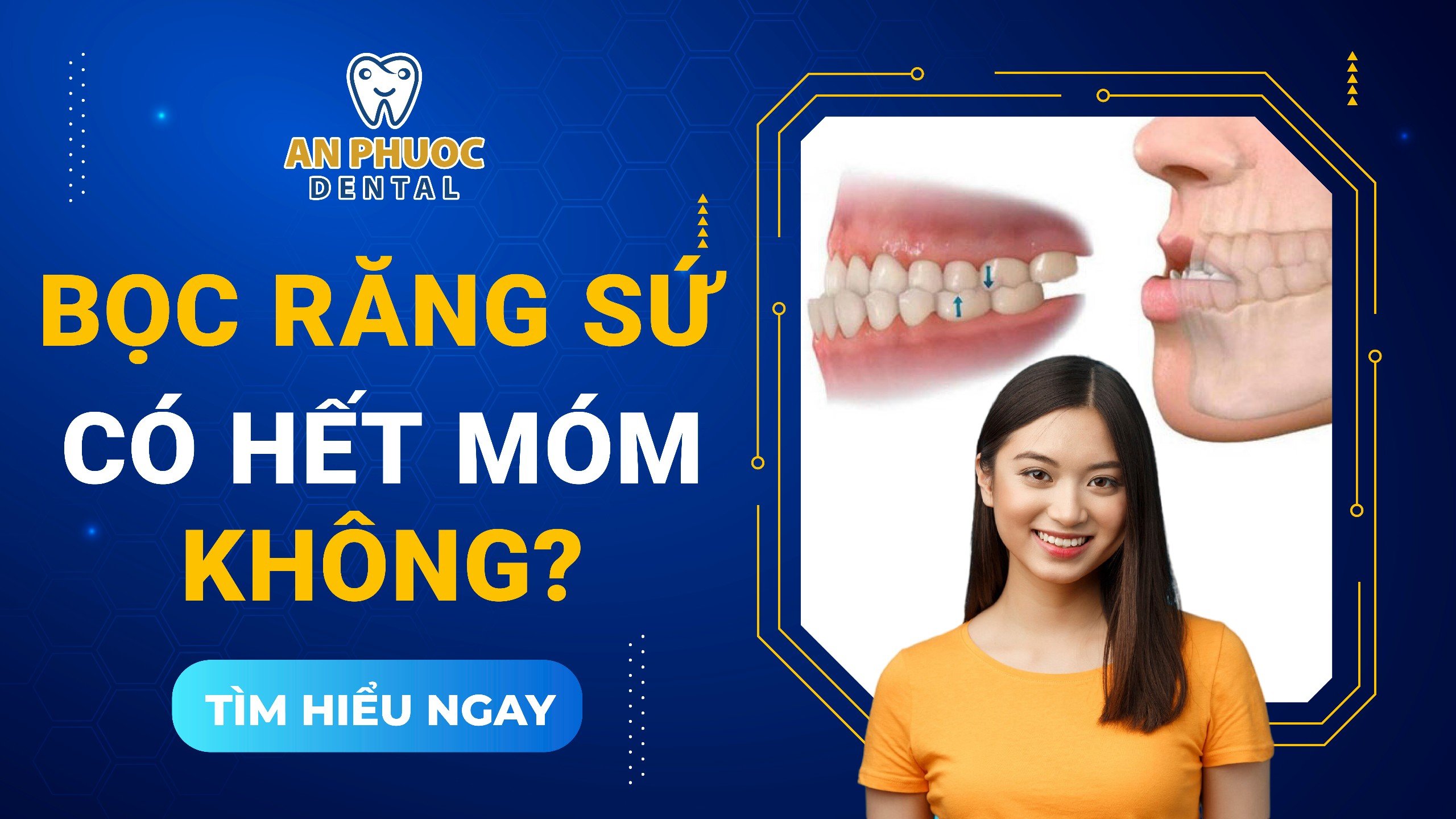 Bọc răng sứ có hết móm không