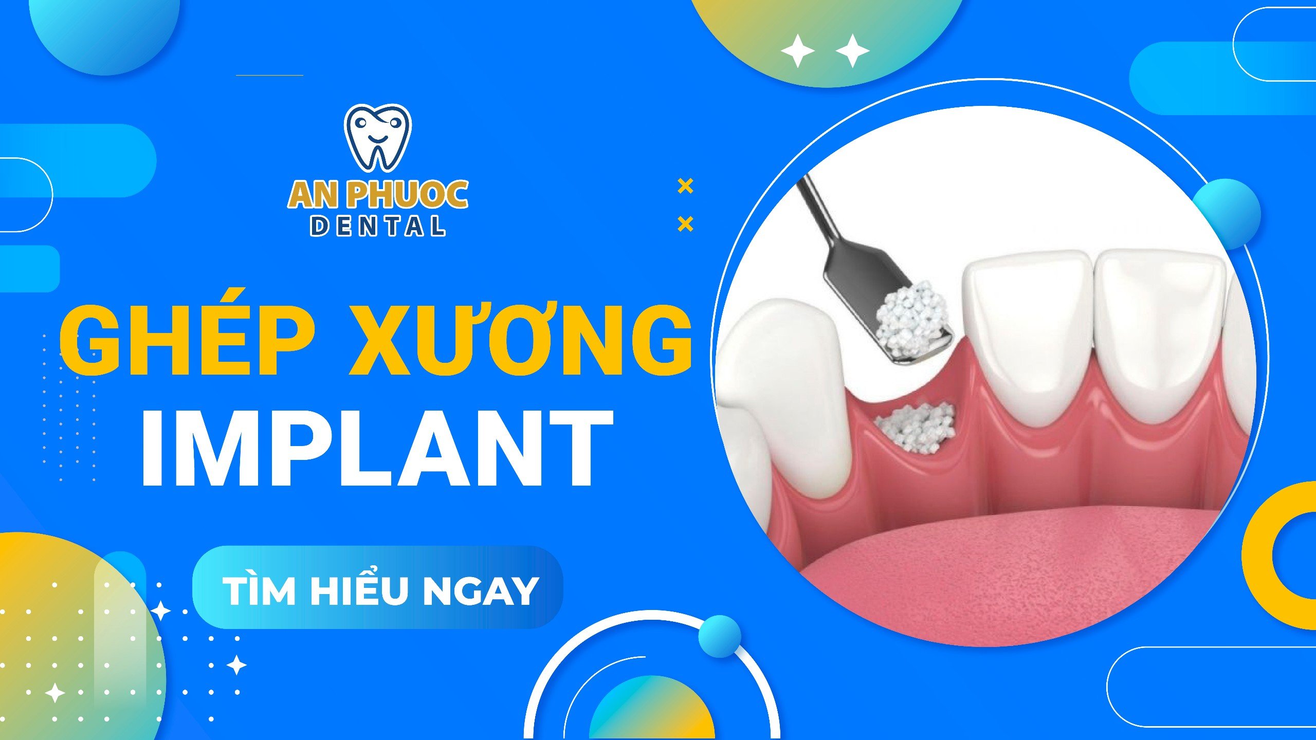 Ghép xương Implant là gì? Trường hợp nào phải ghép xương Implant? Ghép xương Implant