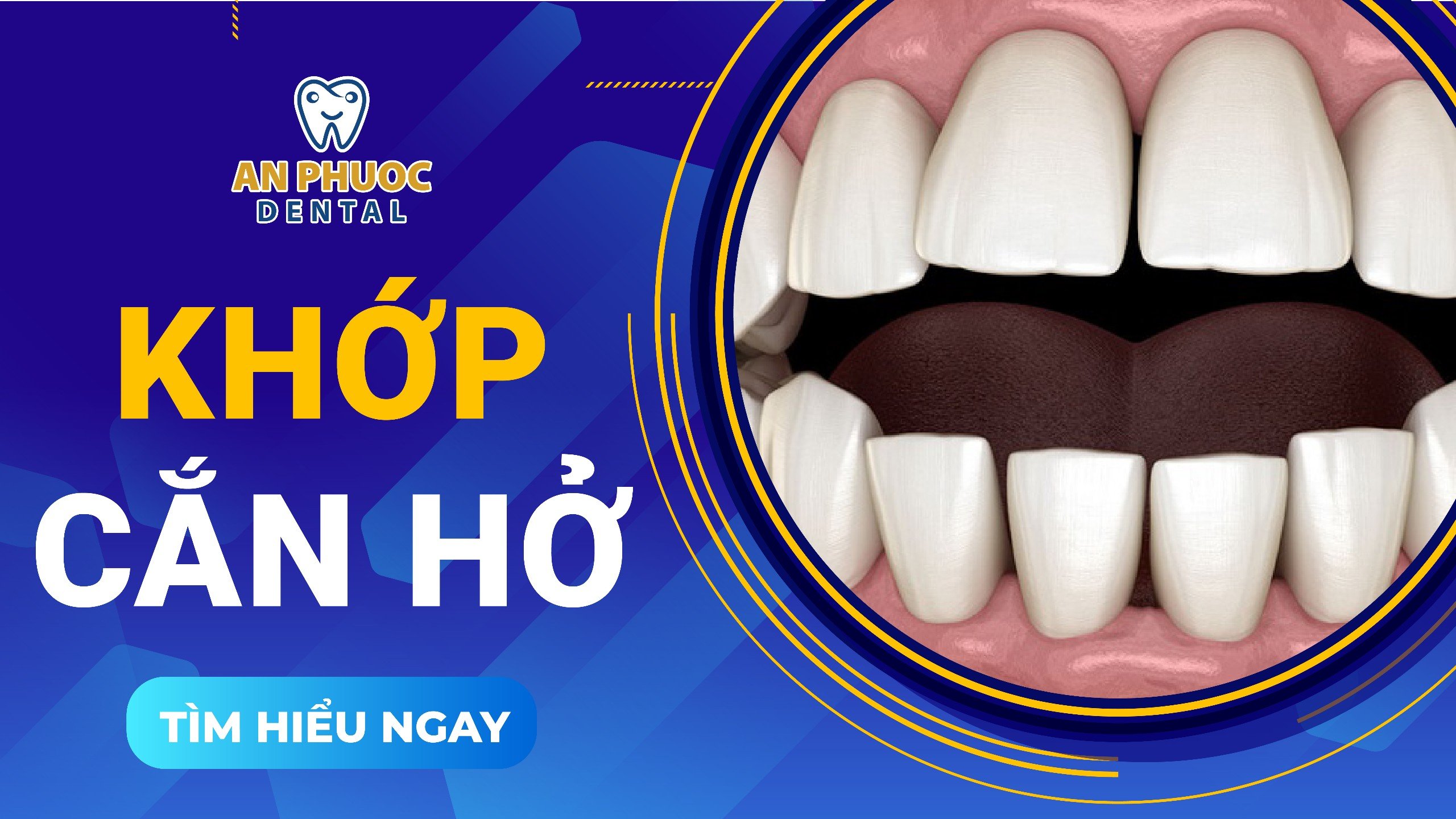 Khớp cắn hở là gì? Đặc điểm nhận biết và phương pháp điều trị