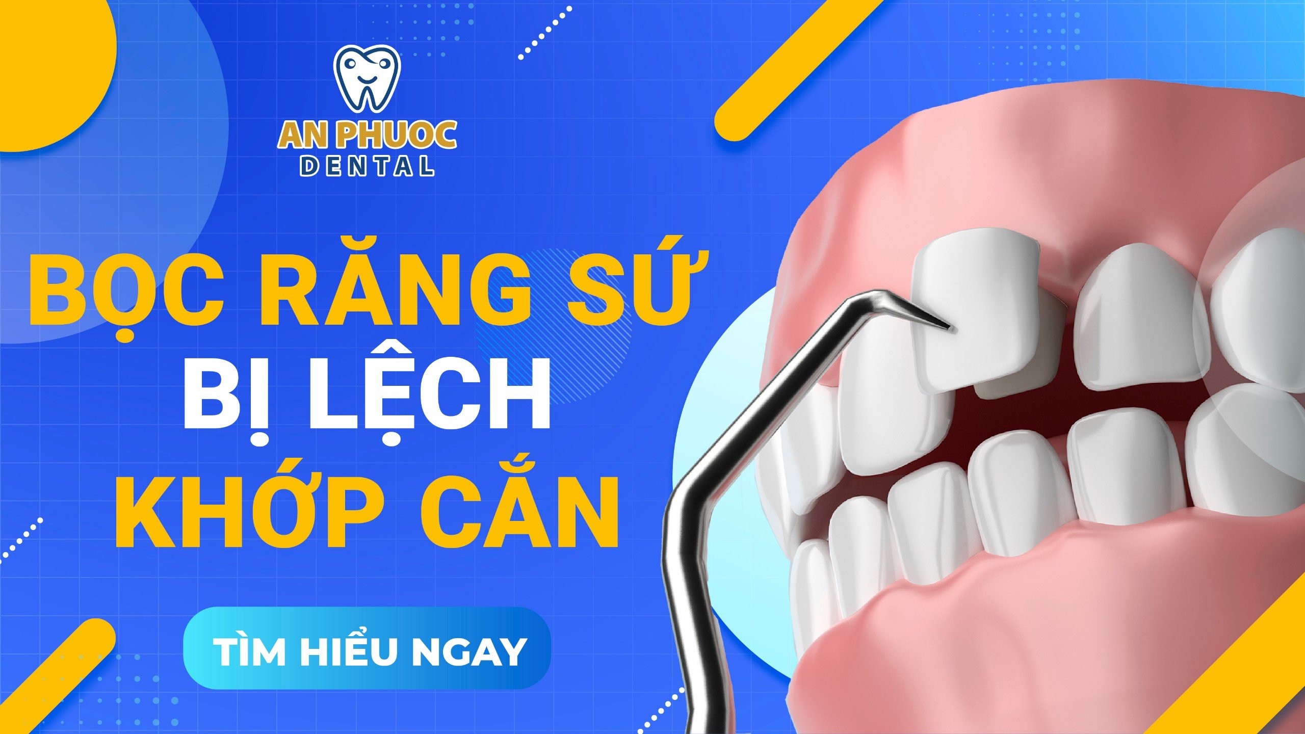 Biến chứng khi bọc răng sứ bị lệch khớp cắn, khắc phục như thế nào? Biến chứng khi bọc răng sứ bị lệch khớp cắn