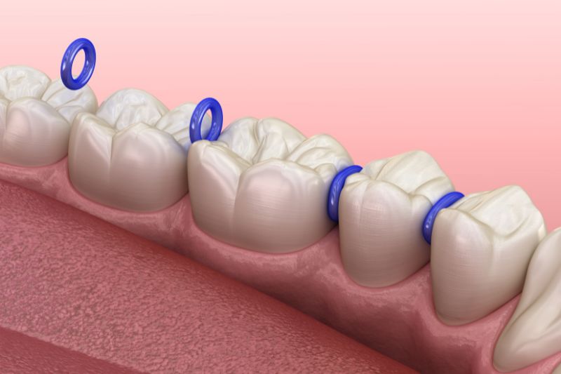 Niềng răng có đau không? Các giai đoạn gây đau khi niềng Đặt thun tách kẽ trong niềng răng giúp tạo khoảng trống cho răng di chuyển
