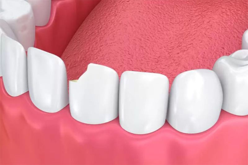 Nguyên nhân và cách khắc phục khi răng sứ bị mẻ Răng sứ bị mẻ đến từ nhiều nguyên nhân khác nhau