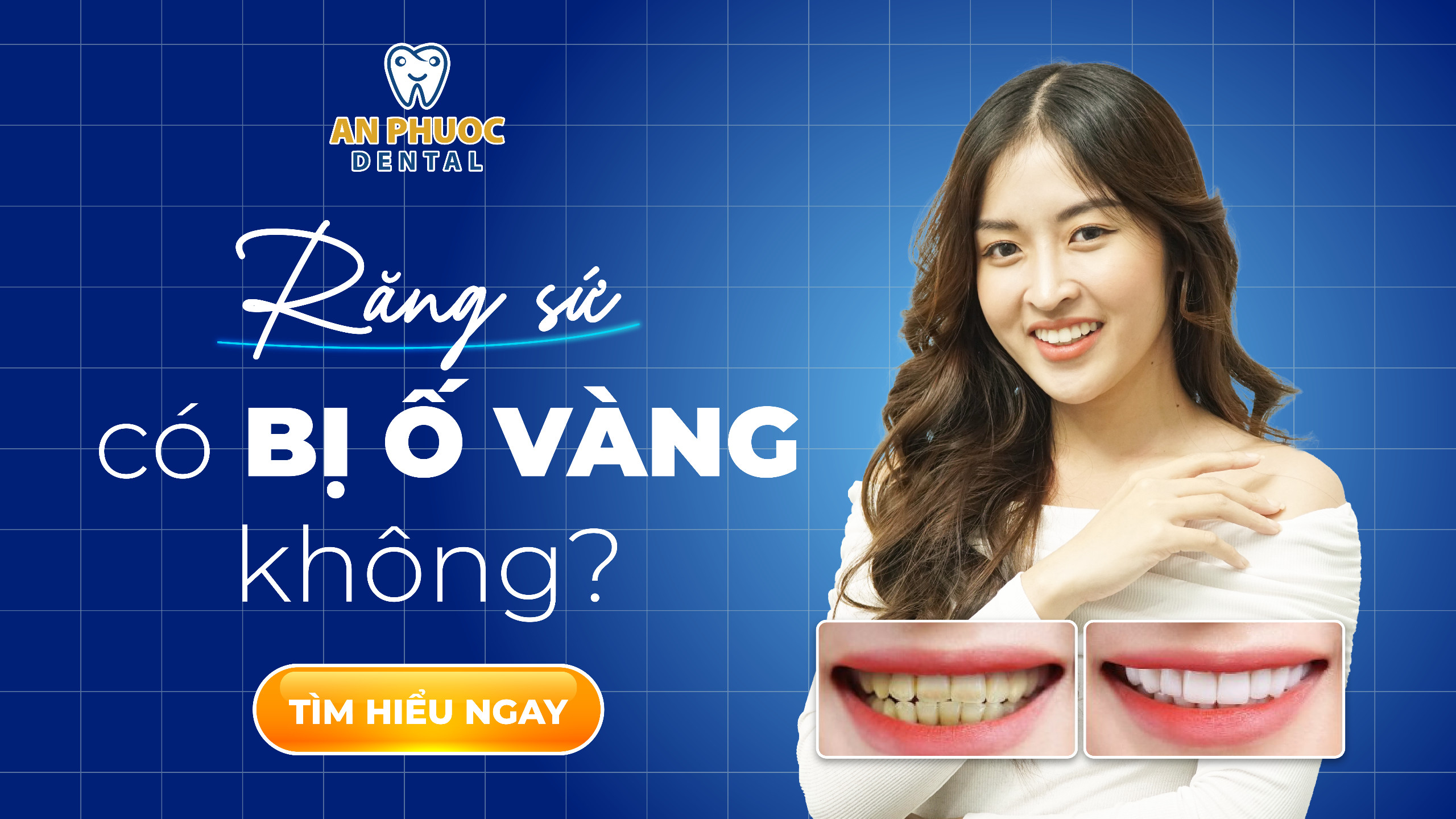 Răng sứ có bị ố vàng không? Nguyên nhân và cách khắc phục hiệu quả Răng sứ có bị ố vàng không - Nha khoa An Phước