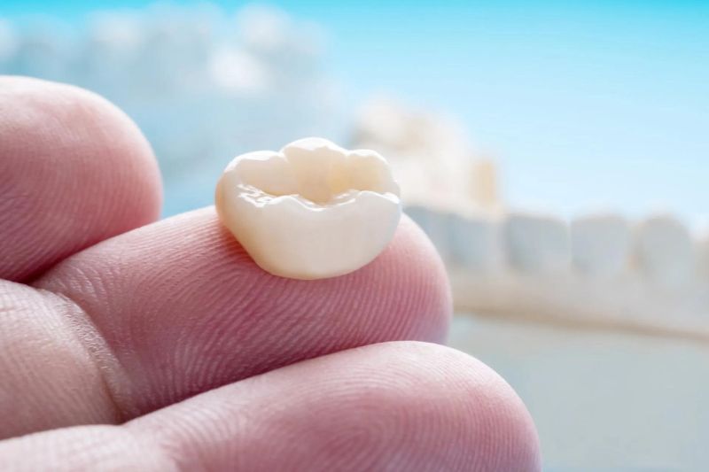 Răng tạm là gì? Vì sao cần gắn răng tạm sau khi mài răng? Răng tạm đóng vai trò quan trọng trong quá trình bọc răng sứ