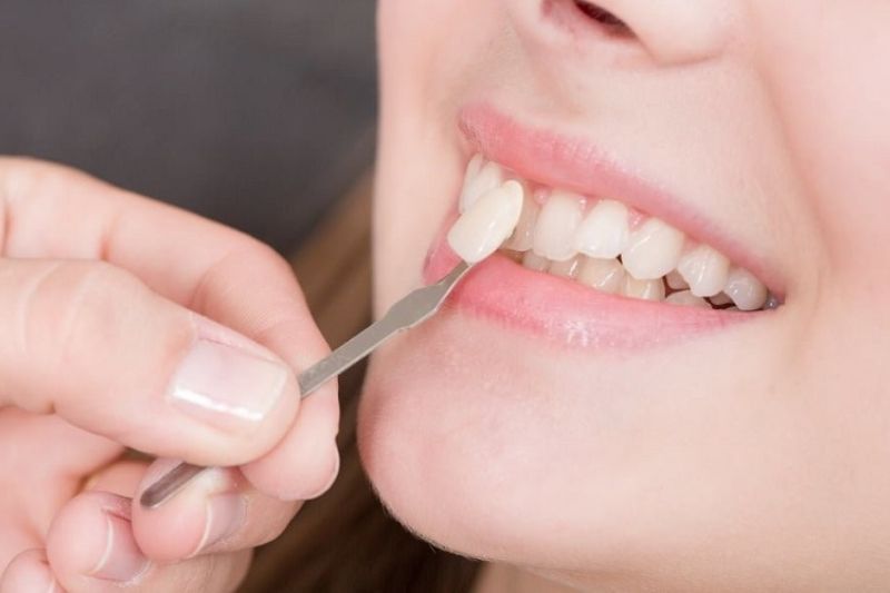 Răng tạm là gì? Vì sao cần gắn răng tạm sau khi mài răng? Răng tạm thời cố định