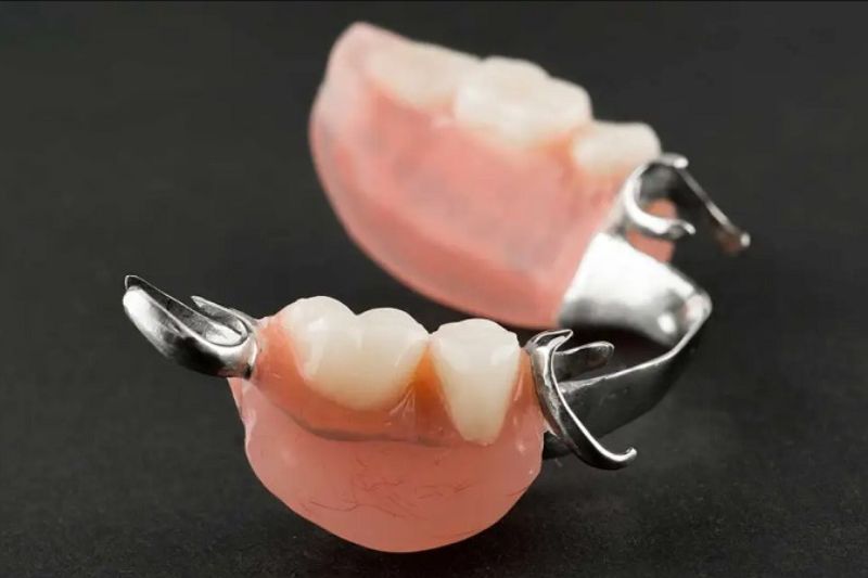 Răng tạm là gì? Vì sao cần gắn răng tạm sau khi mài răng? Răng tạm thời có tháo lắp