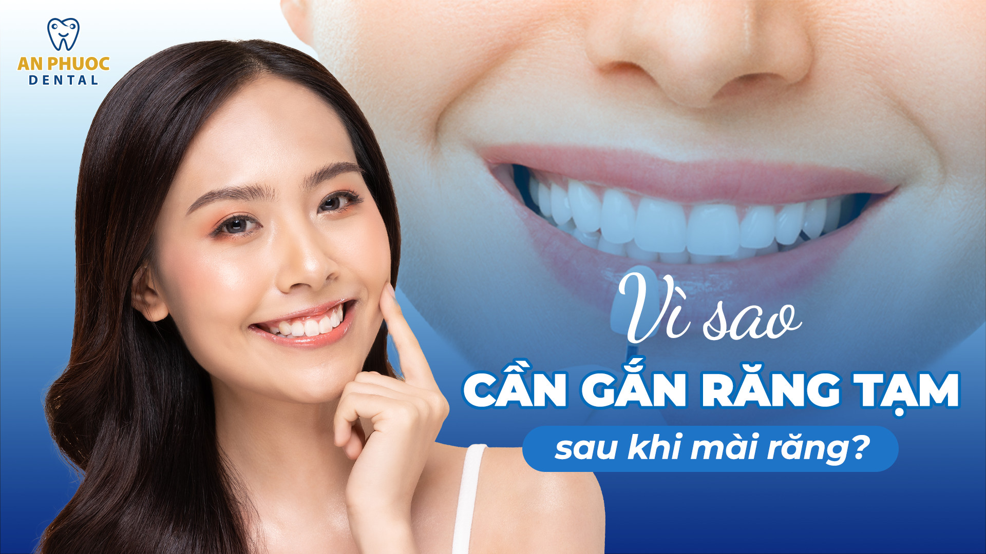 Răng tạm là gì? Vì sao cần gắn răng tạm sau khi mài răng? Răng tạm là gì? Vì sao cần gắn răng tạm sau khi mài răng