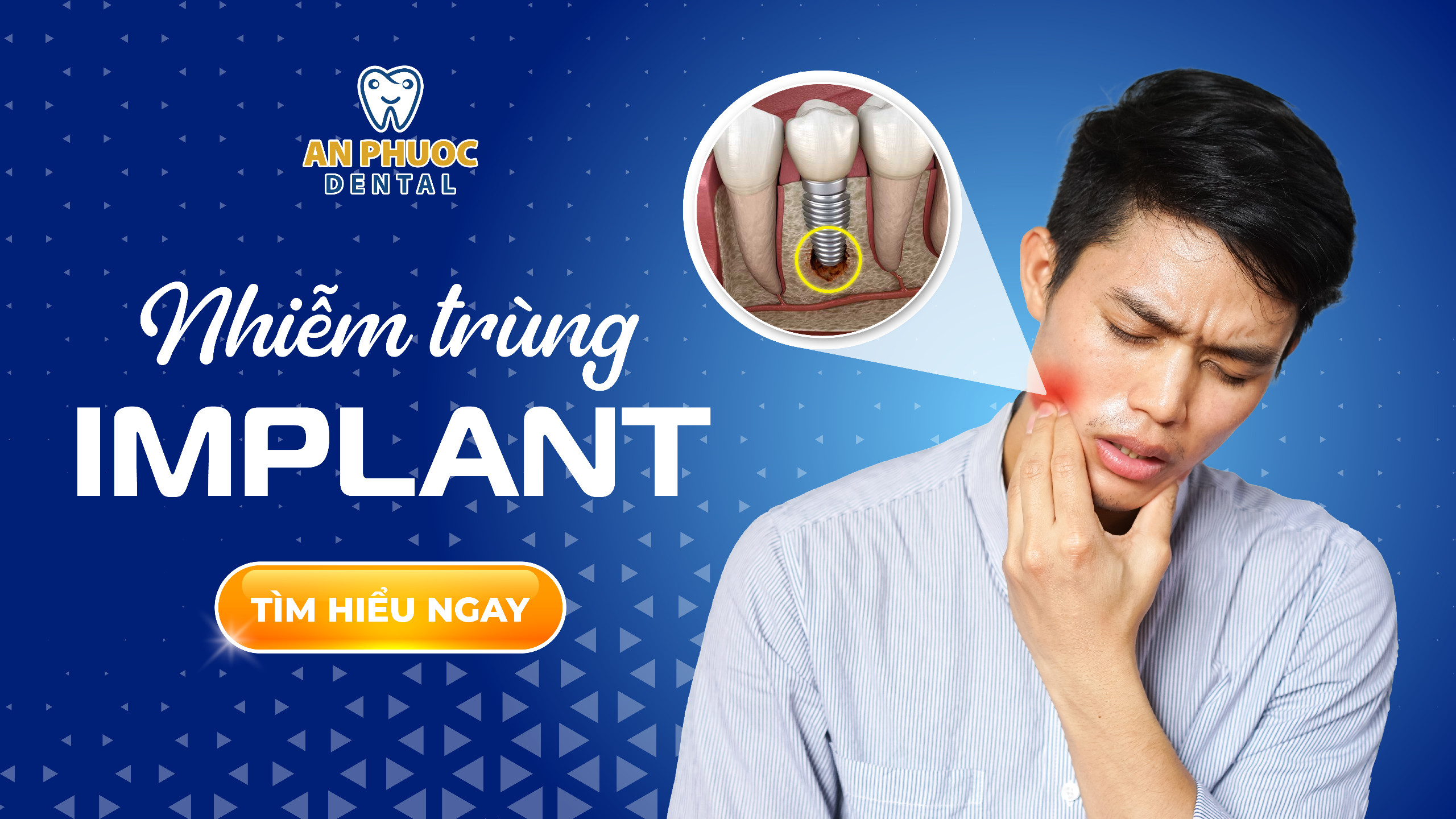 Nhiễm trùng Implant - Nguyên nhân, triệu chứng và cách điều trị Nhiễm trùng Implant - Nguyên nhân, triệu chứng và cách điều trị