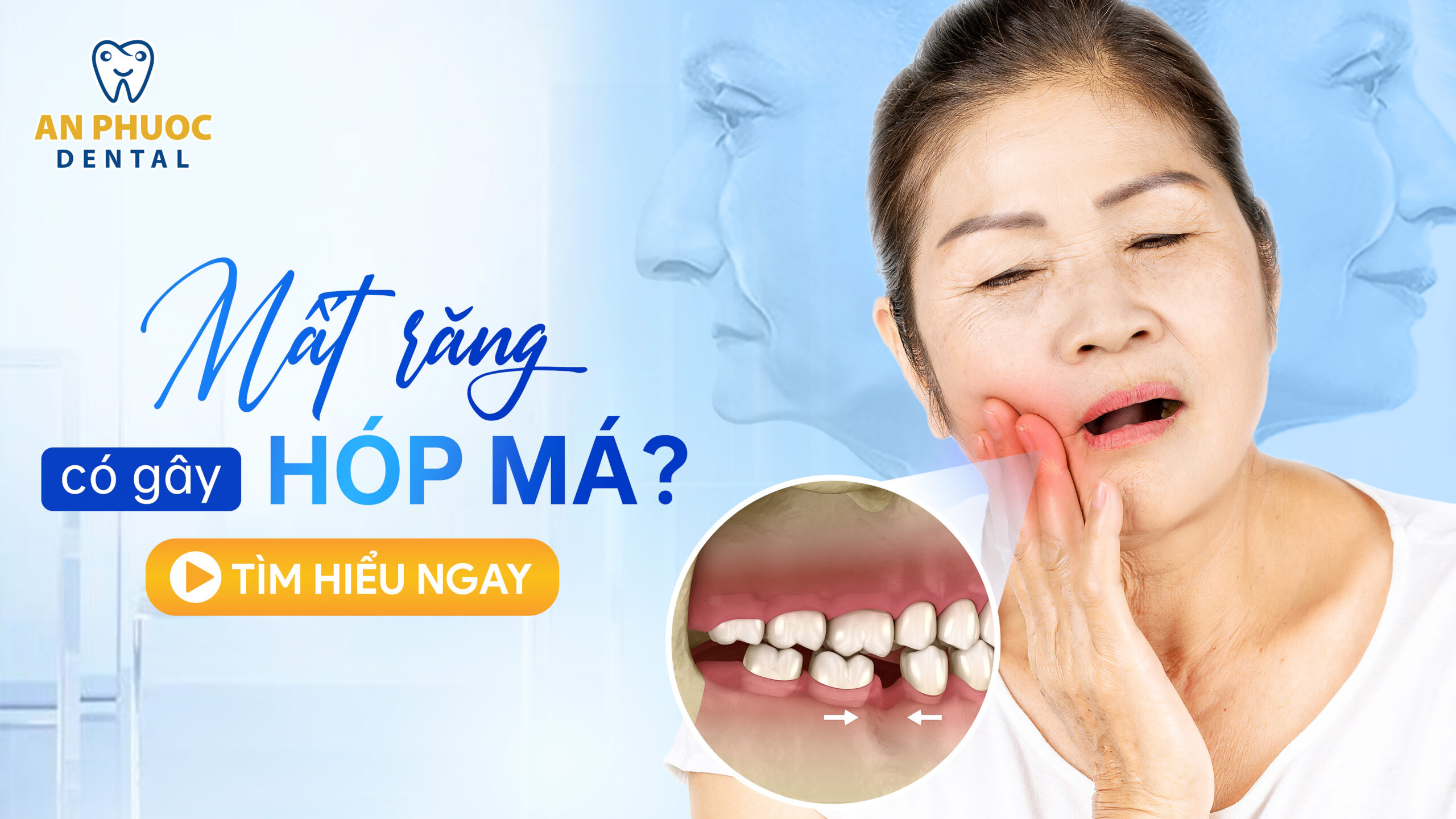 Mất răng hàm có bị hóp má không? Hậu quả và cách khắc phục Mất răng hàm có hóp má không?
