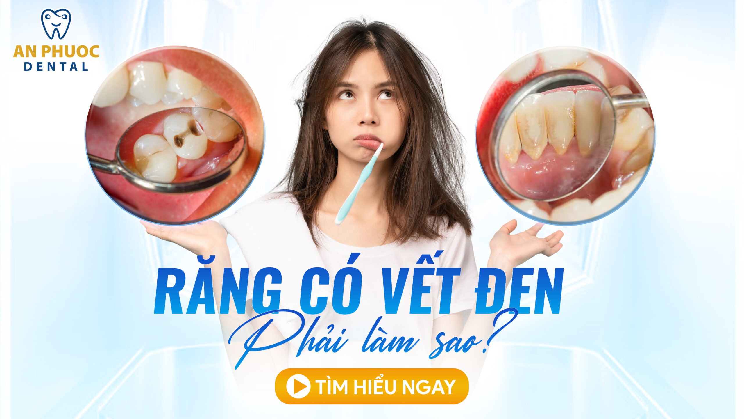 Răng có vết đen: Nguyên nhân và cách loại bỏ hiệu quả