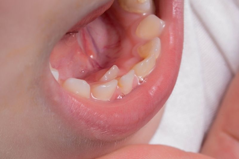 Răng sữa mọc lệch có sao không? Nguyên nhân do đâu? Cấu trúc xương hàm không cân đối dẫn đến tình trạng răng sữa mọc lệch