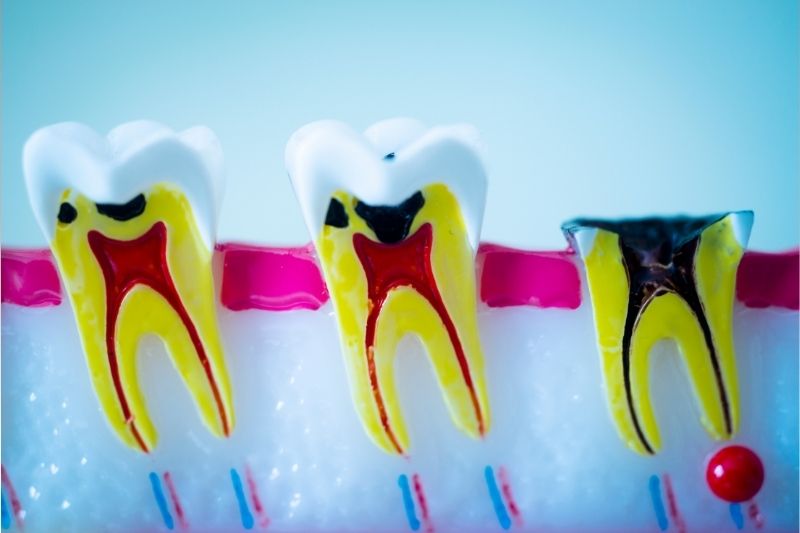Nhận biết biểu hiện sâu răng vào tủy và cách chữa trị Răng sâu vào tuỷ gây những cơn đau nhức kéo dài