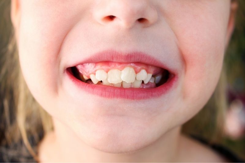 Răng sữa mọc lệch có sao không? Nguyên nhân do đâu? Răng sữa mọc lệch gây ra nhiều ảnh hưởng đến sức khoẻ của trẻ