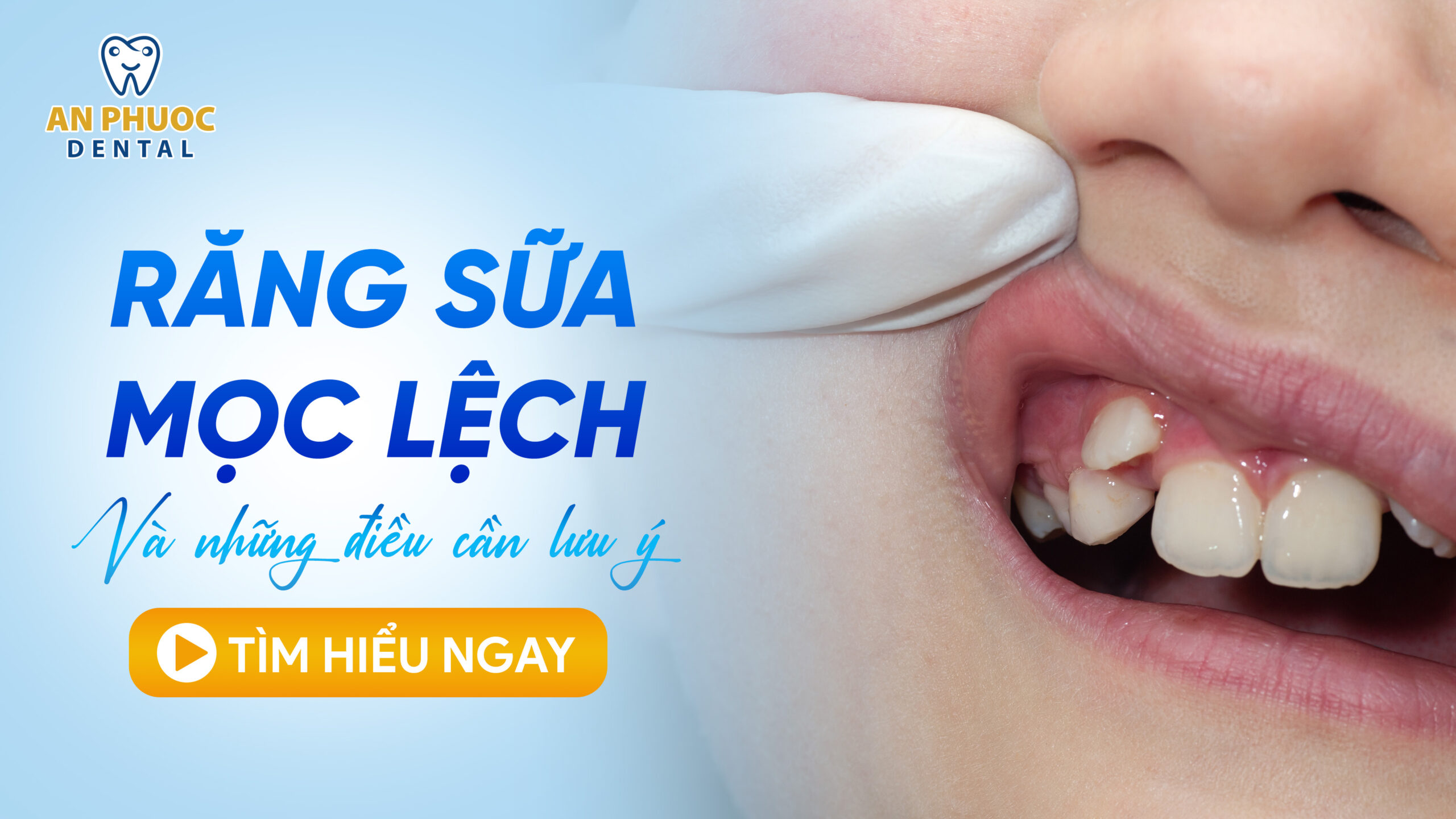 Răng sữa mọc lệch có sao không? Nguyên nhân do đâu? Răng sữa mọc lệch và những điều cần lưu ý