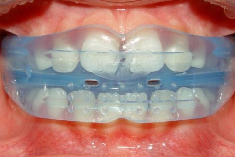 Răng sữa mọc lệch có sao không? Nguyên nhân do đâu? Sử dụng máng định hướng mọc răng để giúp răng mới mọc đúng vị trí