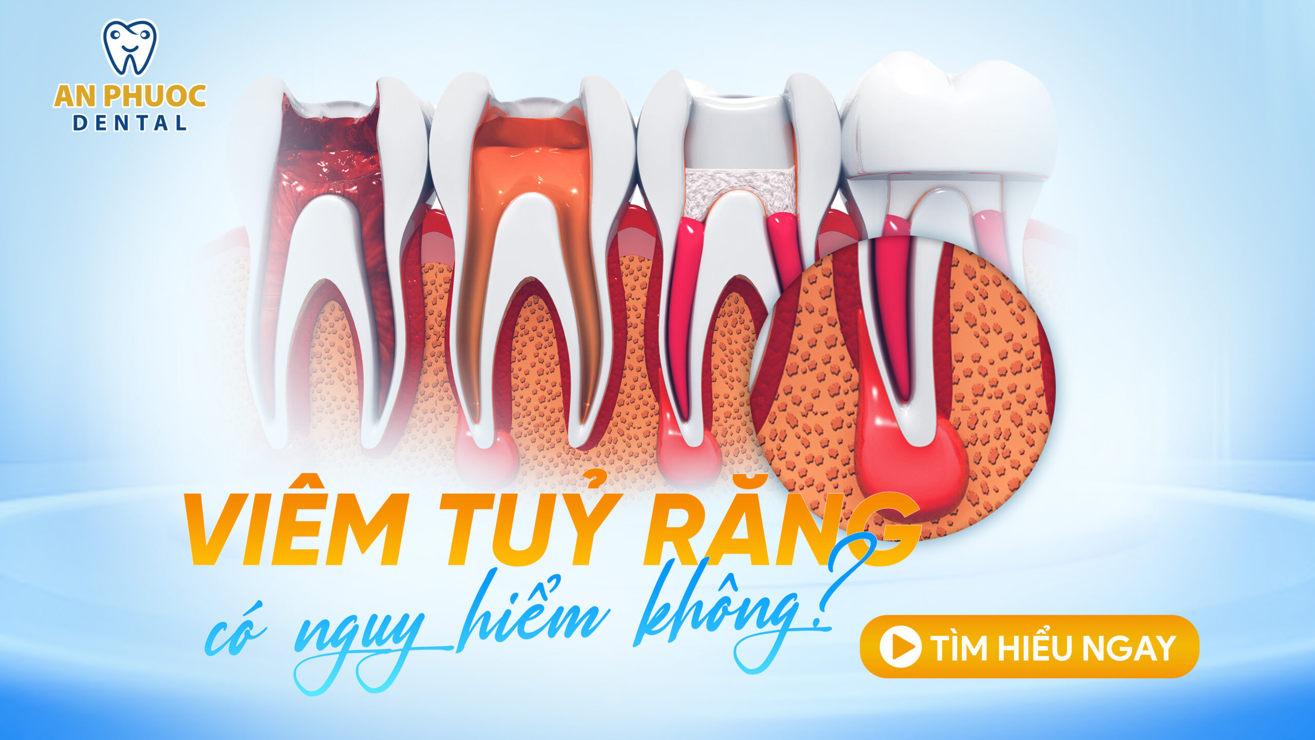 Viêm tuỷ răng có nguy hiểm không? Cách điều trị hiệu quả Viêm tuỷ răng có nguy hiểm không?