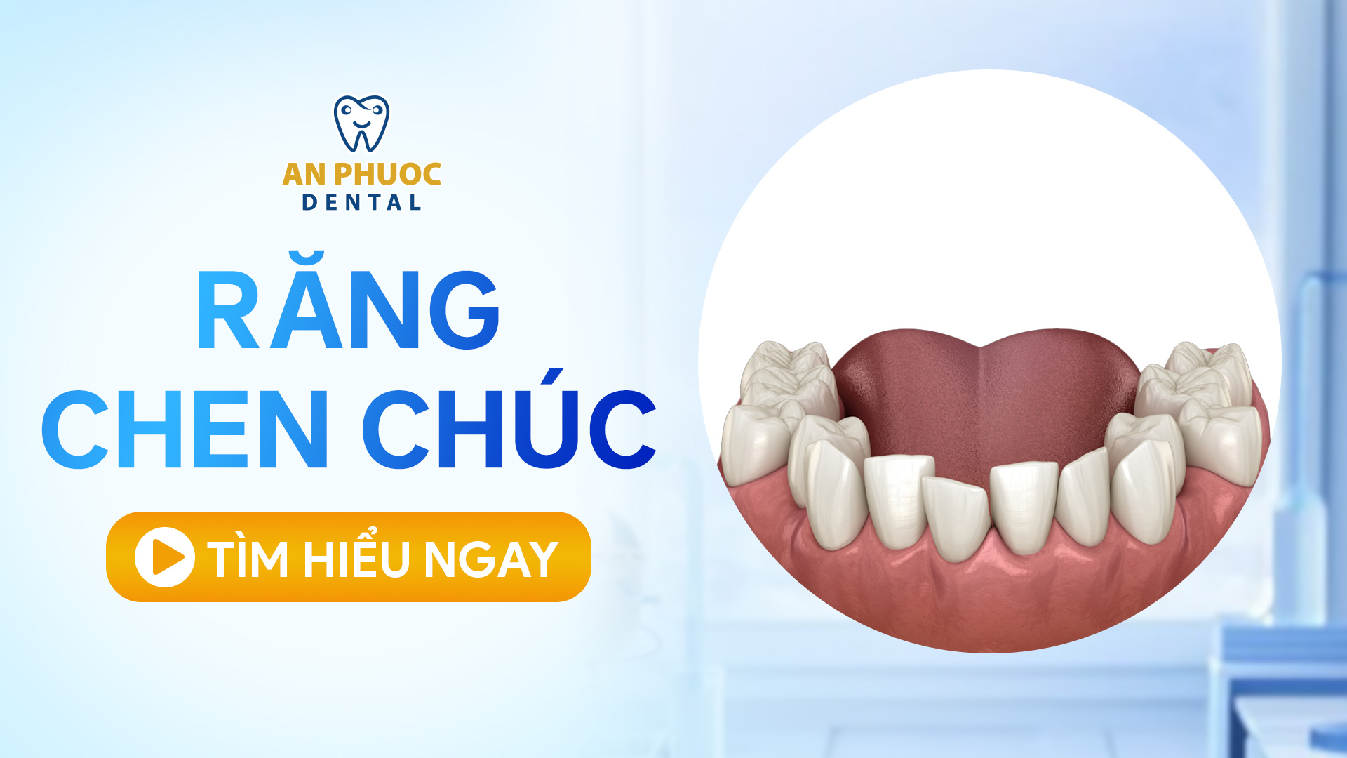 Vì sao răng chen chúc? Giải pháp khắc phục hiệu quả Tình trạng răng mọc chen chúc