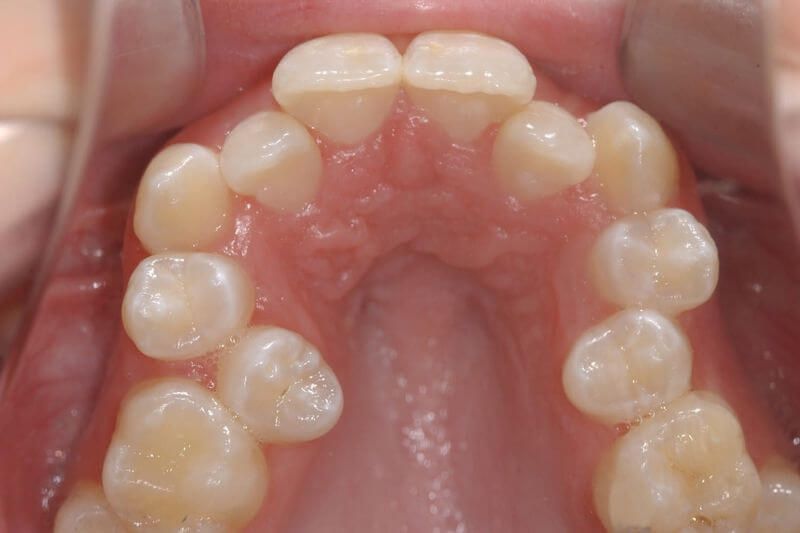 Vì sao răng chen chúc? Giải pháp khắc phục hiệu quả Răng mọc chen chúc