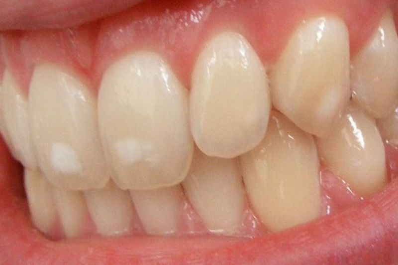 Răng nhiễm fluor là gì? Nguyên nhân và cách khắc phục hiệu quả Răng nhiễm fluor mức độ nhẹ