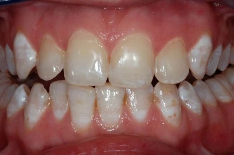 Răng nhiễm fluor là gì? Nguyên nhân và cách khắc phục hiệu quả Răng nhiễm fluor mức độ trung bình
