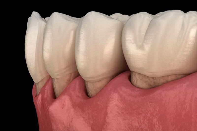 Bị tụt lợi có tự khỏi không? Cách chữa răng bị tụt lợi hiệu quả Tình trạng tụt lợi